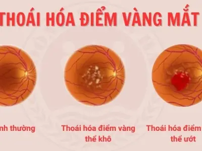 Bệnh thoái hóa điểm vàng là gì? Triệu chứng dễ bị bỏ qua