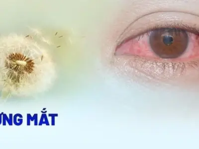Mắt đỏ vì dị ứng - Nguyên nhân tiềm ẩn và cách chăm sóc đúng
