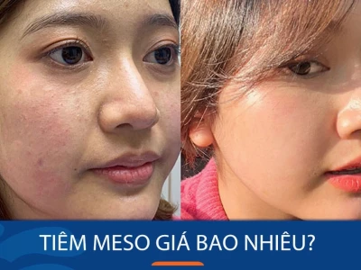 Tiêm Meso Giá Bao Nhiêu? Cẩm Nang Chi Tiết Từ A-Z Năm 2026